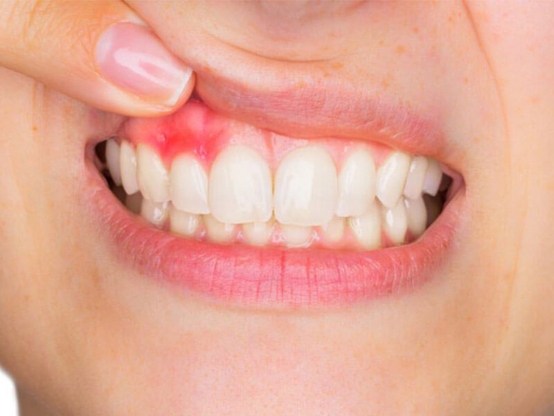 Diş Eti Hastalıkları